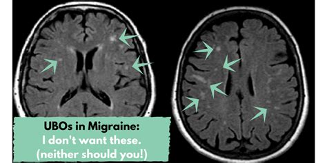 The Gluten & Migraine Connection: What You Need To Know