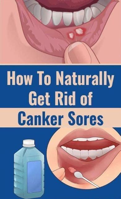 How to cure canker sores and mouth sores? | Healthy Prize