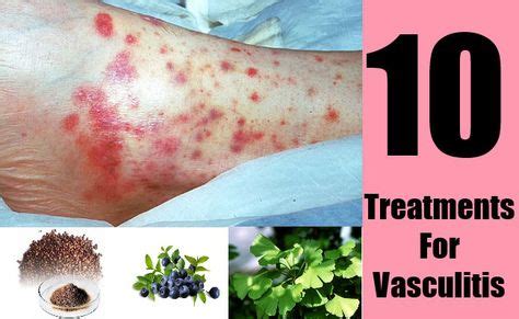 10 Treatments For Vasculitis | Asthma cure, Vasculitis autoimmune ...