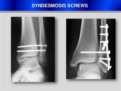 Ankle Syndesmosis TightRope