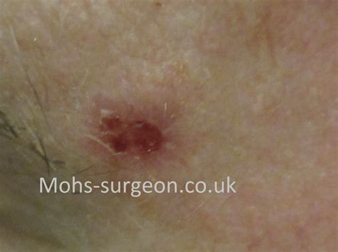 Basal cell carcinoma pictures: BCC on the forehead | Mohs Surgery