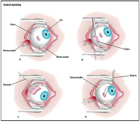 Scleral Buckling - procedure, recovery, removal, pain, complications, time, infection, medication