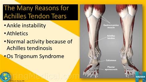 Achilles Tendon Partial Tear