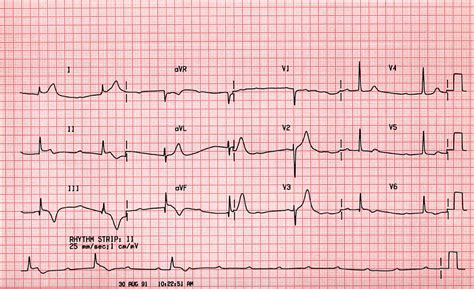 Case B8. ﻿﻿Third Degree AV Block with Acute Myocardial Infaction. St Emlyn's ECG Library