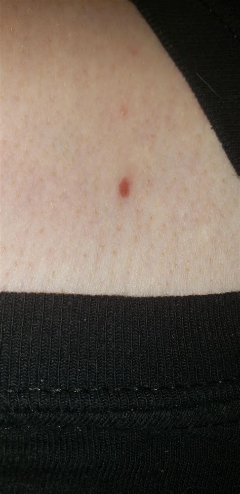 [Skin concern] I've noticed this spot near my collarbone for a few months now but didn't think ...