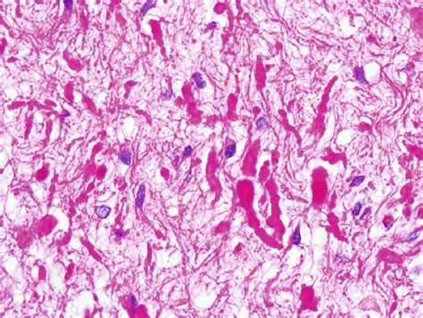 Neuropathology Slides Flashcards | Quizlet