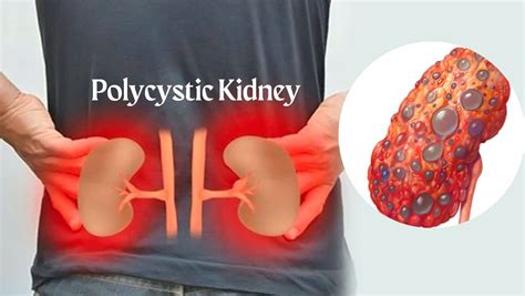 Polycystic Kidney Disease Symptoms