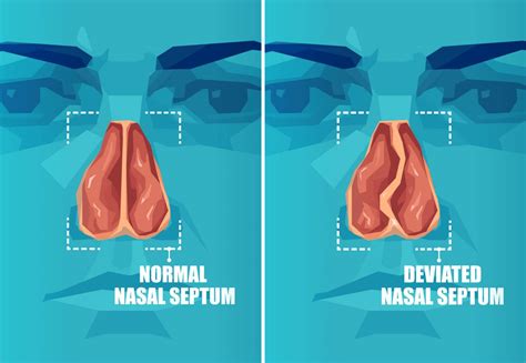 Septoplasty | Biltmore ENT | Sinus Phoenix, AZ - Biltmore Ent