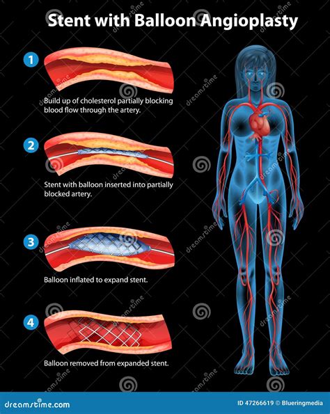 Stent Angioplasty Procedure Stock Vector - Illustration of accumulation, medicine: 47266619