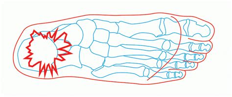 Heel Spur vs Plantar Fasciitis- What is the Difference? - Ergonx