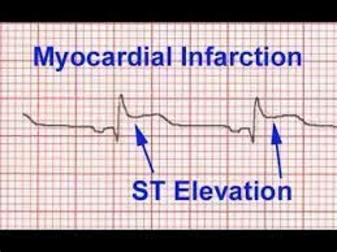 What Does an EKG Look Like In a Heart Attack With Pictures #increasemuscle | St elevation ...