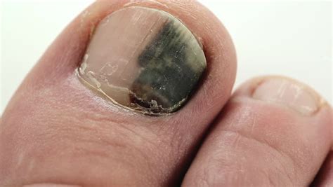 Subungual Hematoma. Bruise Under The Nail Of Big Toe. Injury To The Nail. Sick Nail. Sickly ...