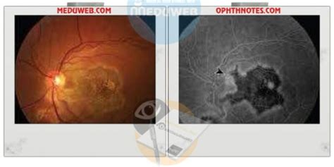 Serpiginous Choroidopathy - Meduweb