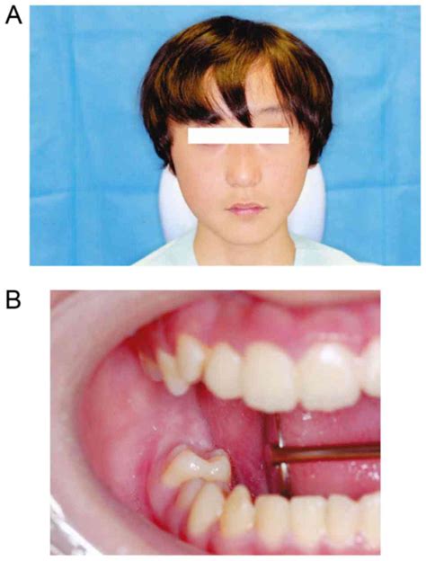 Calcifying cystic odontogenic tumor accompanied by a dentigerous cyst: A case report