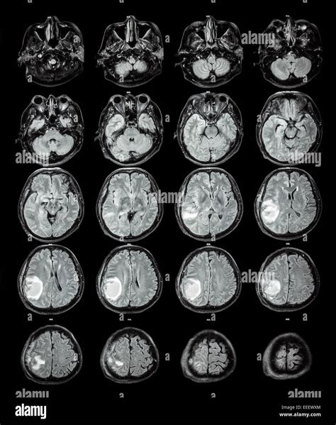 MRI brain : Brain tumor at right parietal lobe Stock Photo - Alamy