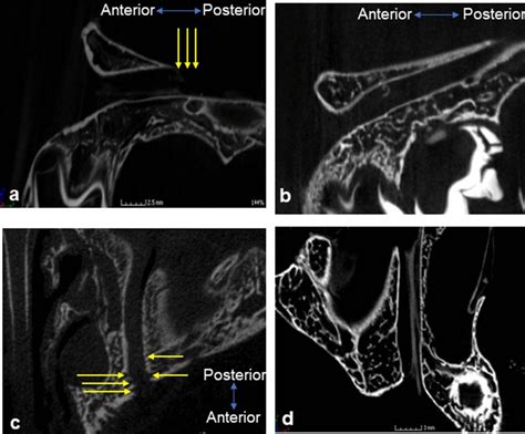 Integrity of walls of the infraorbital canal. a and b Sagittal view... | Download Scientific Diagram