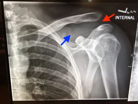 Acromioclavicular Joint Separation, AP XR, Annotated. JETem 2018 - JETem