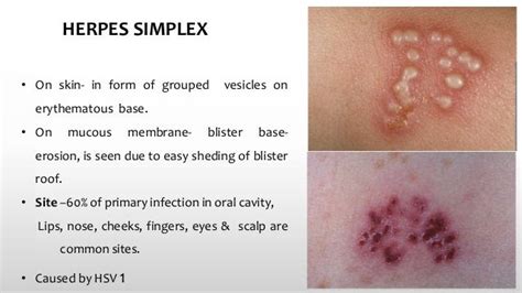 Download Simplex Virus Hsv2 On Buttocks PNG - Wall HD Aja