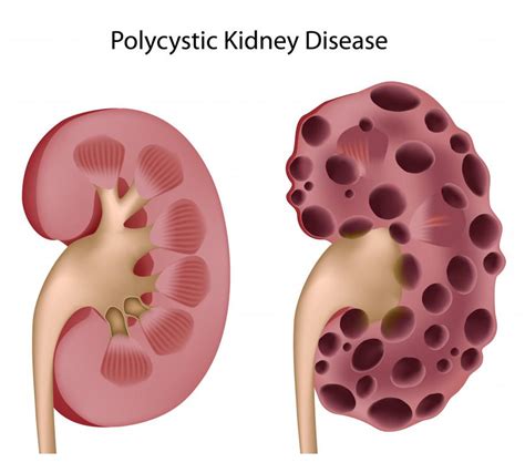 What Is a Kidney Cyst? (with pictures)