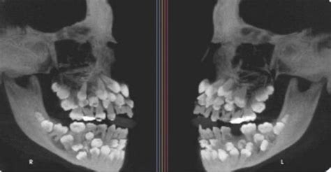 X-ray of a skull with surplus teeth Toddler skull X-rays are terrifying, is it common - Ayupp ...