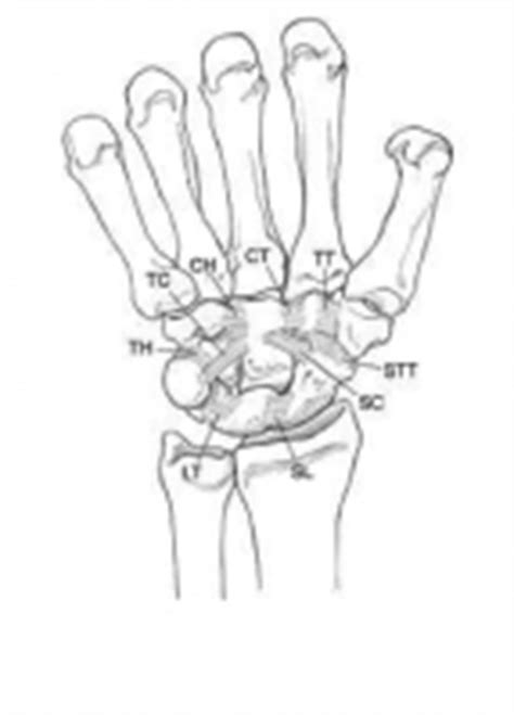 Lunotriquetral dissociation - Physiopedia