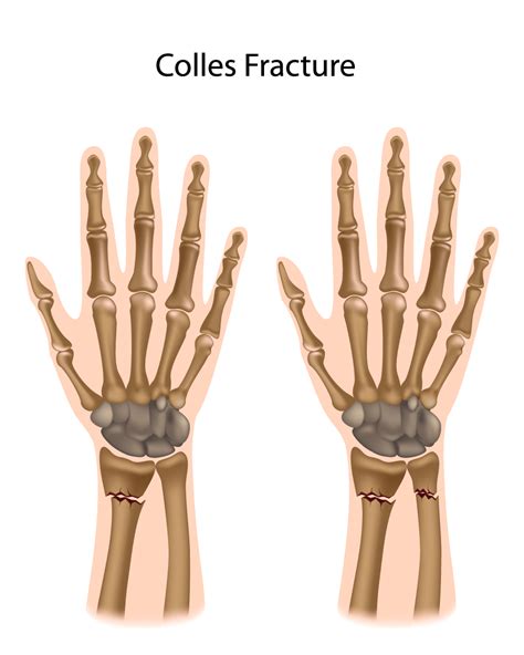 Fractures & Dislocations Archives - G4 Physiotherapy & Fitness