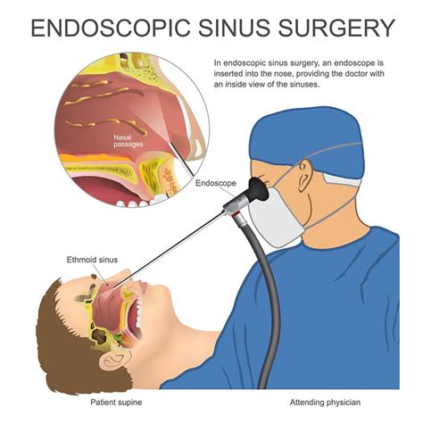 Endoscopic Sinus Surgery Tampa FL, Nasal & Sinus Services