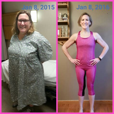 Before & After - 1 year gastric sleeve anniversary - Member Photo Gallery - BariatricPal