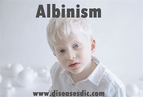 Albinism: causes, symptoms, treatment and prevention