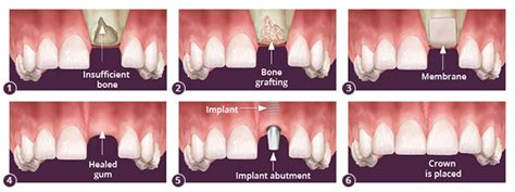 Brooklyn Bone Grafts | Dental Bone Grafting in Brooklyn NY