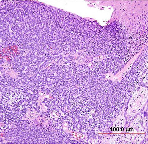 Pathology of Cervical Carcinoma | GLOWM