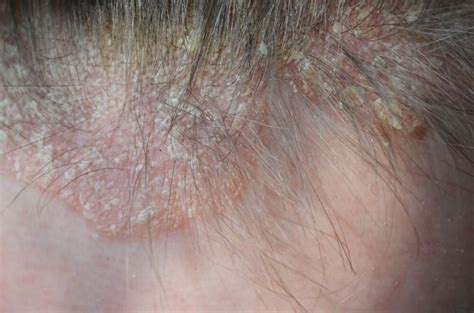 Scalp Psoriasis: What Dermatologists Wish You Knew | Reader's Digest