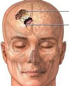 Traumatismo craneal - Enciclopedia Médica Ferato