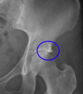 Femoro acetabular impingement syndrome pincer is a stiff hip in the young adult.