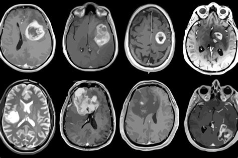 Aggressive brain tumor mapped in genetic, molecular detail – Washington University School of ...