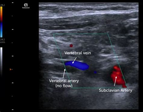 13. Vertebral Artery Pathologies | 123sonography