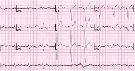 Estimating undiagnosed abnormal heart rhythm cases in older adults - School of Public Health ...