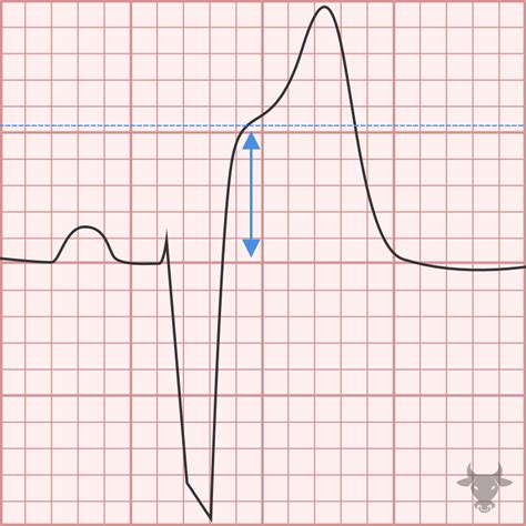 Sgarbossa Criteria | ECG Stampede