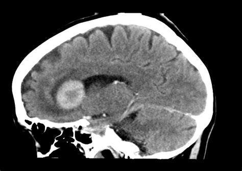 Normal Brain Ct Scan Labeled