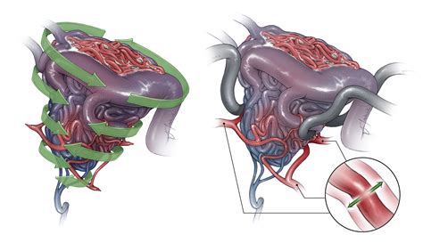 Nuances in AVM Resection | The Neurosurgical Atlas