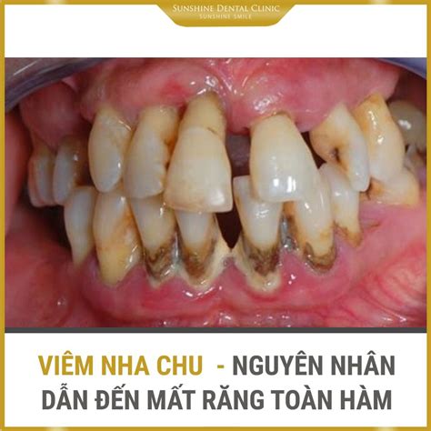 VIÊM NHA CHU-NGUYÊN NHÂN DẪN ĐẾN MẤT RĂNG TOÀN HÀM