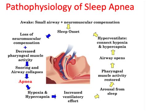 Sleep Apnea and Sleep Architecture Flashcards | Quizlet