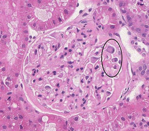 Membranous Glomerulonephropathy – Atlas of Renal Lesions in Proteinuric Dogs