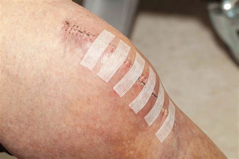 How to Care for a Surgical Wound - Incision Care Made Easy