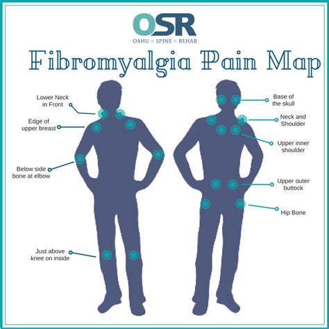 Physical Therapy for Fibromyalgia