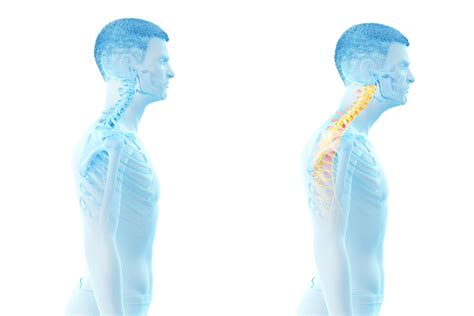 How to Correct Forward Head Posture | Greater Austin Pain Center