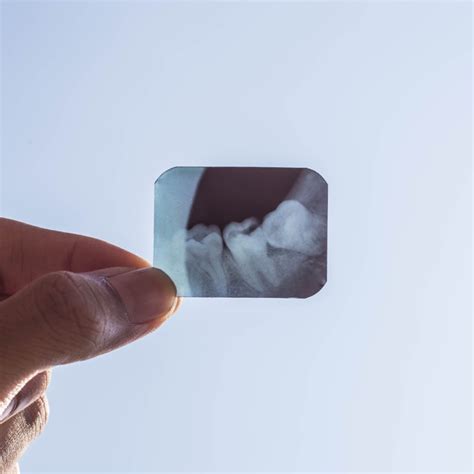 Signs You Have an Impacted Tooth - Rockwall Oral Surgery