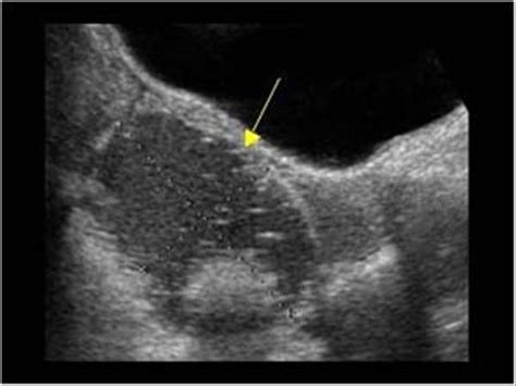 Gynaecology | 3.2 Adnexa : Case 3.2.2 Dermoid cysts / cystic teratomas | Ultrasound Cases