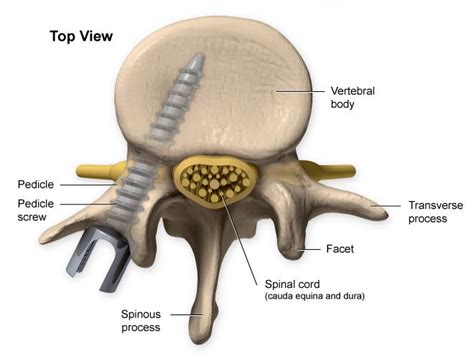 Direct screw repair of pars interarticularis offers satisfactory outcomes in adolescents | Ortho ...