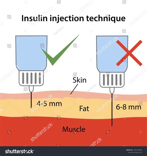 89 Insulin Injection Technique Images, Stock Photos & Vectors | Shutterstock